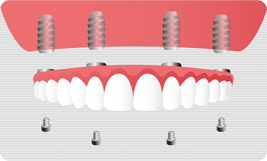 All-on-4（オールオン４）の画像
