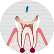 根管治療