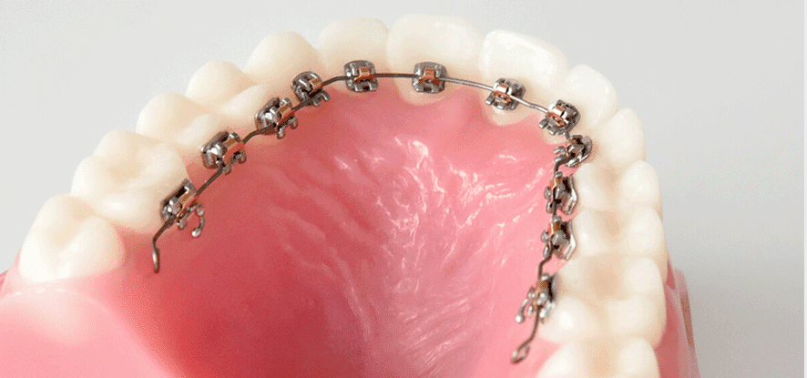 見えない裏側矯正