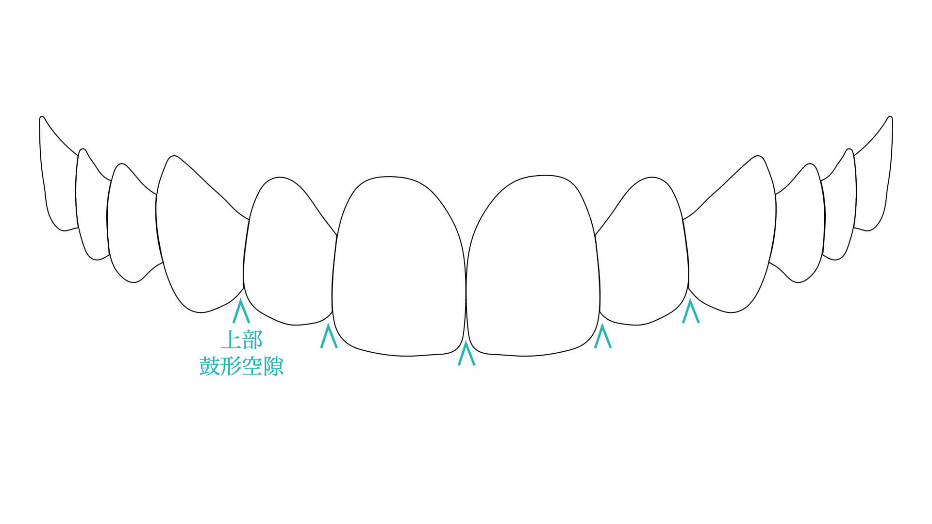 上部鼓形空隙（じょうぶこけいくうげき）
